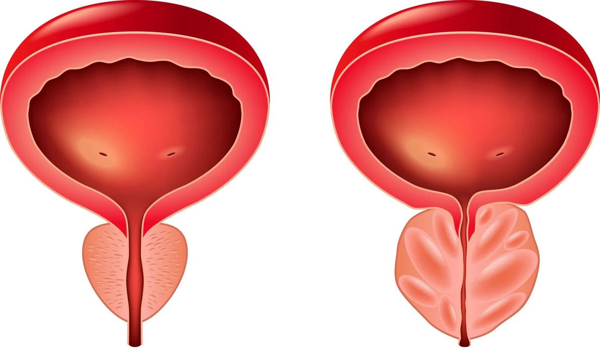 normalna i bolesna prostata